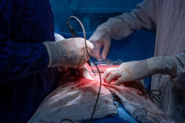 Hastane, cerrah, ameliyat, ameliyat, doktor, cerrahi, hasta, ilaç, kişi, hemşire, sağlık, takım çalışması, mide ameliyatı.