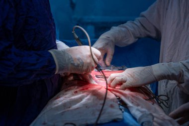 Hastane, cerrah, ameliyat, ameliyat, doktor, cerrahi, hasta, ilaç, kişi, hemşire, sağlık, takım çalışması, mide ameliyatı.