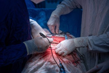 Hastane, cerrah, ameliyat, ameliyat, doktor, cerrahi, hasta, ilaç, kişi, hemşire, sağlık, takım çalışması, mide ameliyatı.