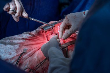 Hastane, cerrah, ameliyat, ameliyat, doktor, cerrahi, hasta, ilaç, kişi, hemşire, sağlık, takım çalışması, mide ameliyatı.