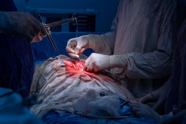 Hastane, cerrah, ameliyat, ameliyat, doktor, cerrahi, hasta, ilaç, kişi, hemşire, sağlık, takım çalışması, mide ameliyatı.