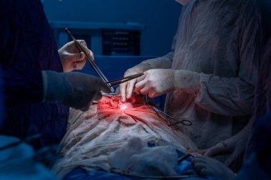 Hastane, cerrah, ameliyat, ameliyat, doktor, cerrahi, hasta, ilaç, kişi, hemşire, sağlık, takım çalışması, mide ameliyatı.