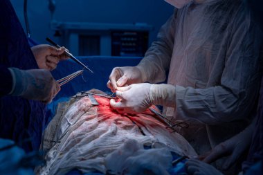 Hastane, cerrah, ameliyat, ameliyat, doktor, cerrahi, hasta, ilaç, kişi, hemşire, sağlık, takım çalışması, mide ameliyatı.