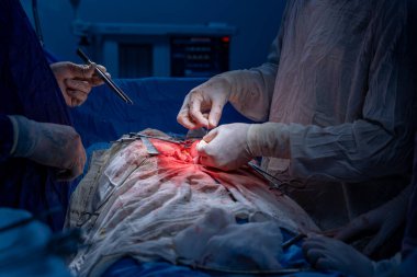 Hastane, cerrah, ameliyat, ameliyat, doktor, cerrahi, hasta, ilaç, kişi, hemşire, sağlık, takım çalışması, mide ameliyatı.