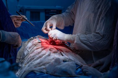 Hastane, cerrah, ameliyat, ameliyat, doktor, cerrahi, hasta, ilaç, kişi, hemşire, sağlık, takım çalışması, mide ameliyatı.