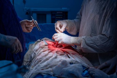 Hastane, cerrah, ameliyat, ameliyat, doktor, cerrahi, hasta, ilaç, kişi, hemşire, sağlık, takım çalışması, mide ameliyatı.