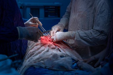 Hastane, cerrah, ameliyat, ameliyat, doktor, cerrahi, hasta, ilaç, kişi, hemşire, sağlık, takım çalışması, mide ameliyatı.