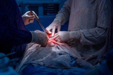 Hastane, cerrah, ameliyat, ameliyat, doktor, cerrahi, hasta, ilaç, kişi, hemşire, sağlık, takım çalışması, mide ameliyatı.