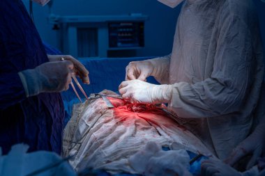 Hastane, cerrah, ameliyat, ameliyat, doktor, cerrahi, hasta, ilaç, kişi, hemşire, sağlık, takım çalışması, mide ameliyatı.