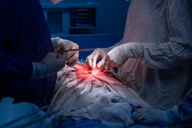 Hastane, cerrah, ameliyat, ameliyat, doktor, cerrahi, hasta, ilaç, kişi, hemşire, sağlık, takım çalışması, mide ameliyatı.