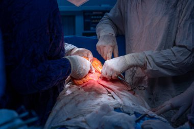 Hastane, cerrah, ameliyat, ameliyat, doktor, cerrahi, hasta, ilaç, kişi, hemşire, sağlık, takım çalışması, mide ameliyatı.