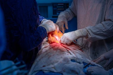 Hastane, cerrah, ameliyat, ameliyat, doktor, cerrahi, hasta, ilaç, kişi, hemşire, sağlık, takım çalışması, mide ameliyatı.