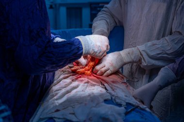 Hastane, cerrah, ameliyat, ameliyat, doktor, cerrahi, hasta, ilaç, kişi, hemşire, sağlık, takım çalışması, mide ameliyatı.