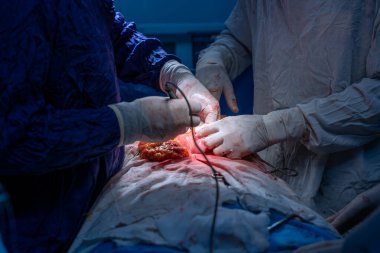 Hastane, cerrah, ameliyat, ameliyat, doktor, cerrahi, hasta, ilaç, kişi, hemşire, sağlık, takım çalışması, mide ameliyatı.