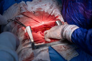 Hastane, cerrah, ameliyat, ameliyat, doktor, cerrahi, hasta, ilaç, kişi, hemşire, sağlık, takım çalışması, mide ameliyatı.