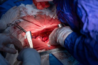 Hastane, cerrah, ameliyat, ameliyat, doktor, cerrahi, hasta, ilaç, kişi, hemşire, sağlık, takım çalışması, mide ameliyatı.