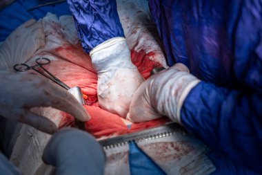 Hastane, cerrah, ameliyat, ameliyat, doktor, cerrahi, hasta, ilaç, kişi, hemşire, sağlık, takım çalışması, mide ameliyatı.