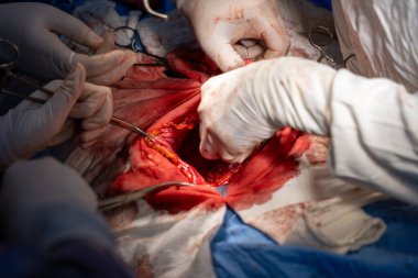 Hastane, cerrah, ameliyat, ameliyat, doktor, cerrahi, hasta, ilaç, kişi, hemşire, sağlık, takım çalışması, mide ameliyatı.