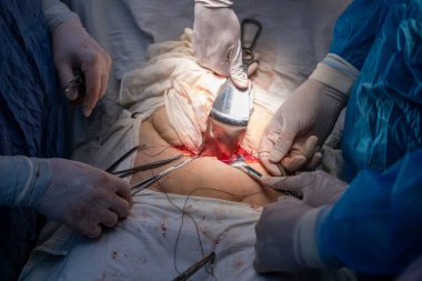 Bir grup cerrah bir hastaya ameliyat yapıyor. Cerrahlar görevlerine odaklandığı için sahne yoğun ve ciddi. Hasta masanın üzerinde yatıyor.