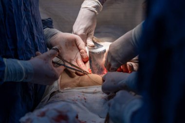 Bir grup cerrah bir hastaya ameliyat yapıyor. Cerrahlar görevlerine odaklandığı için sahne yoğun ve ciddi. Hasta masanın üzerinde yatıyor.