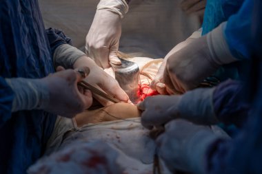 Bir grup cerrah bir hastaya ameliyat yapıyor. Cerrahlar görevlerine odaklandığı için sahne yoğun ve ciddi. Hasta masanın üzerinde yatıyor.