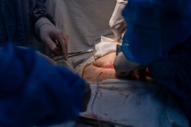 Bir cerrah bir hastanın midesini kesiyor. Hasta mavi bir elbise giyiyor.