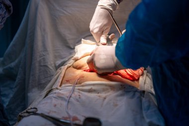 Bir cerrah bir hastaya ameliyat yapıyor. Hastanın kanaması var ve cerrah dokuyu kesmek için neşter kullanıyor. Sahne yoğun ve dramatik.