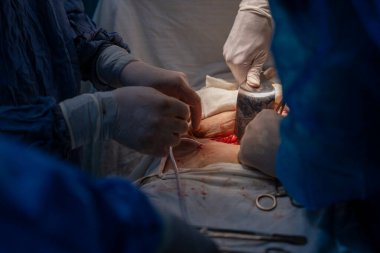 Bir cerrah bir hastaya ameliyat yapıyor. Cerrah ve diğer tıp uzmanları hastanın hayatını kurtarmak için birlikte çalıştığı için sahne yoğun ve ciddi. Eldiven kullanımı.