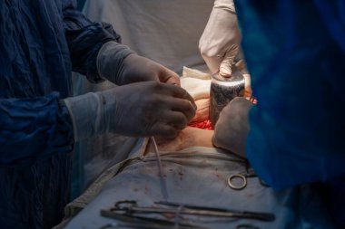 Bir cerrah bir hastaya ameliyat yapıyor. Olay yeri karanlık ve yoğun. Cerrah ve diğer tıbbi personel eldiven ve maske takıyor. Hasta masanın üzerinde yatıyor.