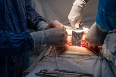 Bir cerrah bir hastanın midesini kesiyor. Cerrahlar hayat kurtaran bir ameliyat yaparken sahne yoğun ve ciddi.