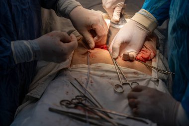 Bir grup cerrah bir hastaya ameliyat yapıyor. Cerrahlar görevlerine odaklandığı için sahne yoğun ve ciddi. Hasta masanın üzerinde yatıyor.