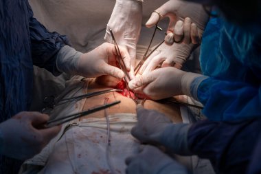 Bir grup cerrah bir hastaya ameliyat yapıyor. Cerrahlar görevlerine odaklandığı için sahne yoğun ve ciddi. Hasta masanın üzerinde yatıyor.