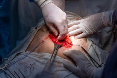 Bir cerrah bir hastanın midesini kesiyor. Hasta hastanede ve olay yeri çok ciddi.