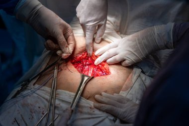 Bir grup cerrah bir hastaya ameliyat yapıyor. Hastanın midesi açık ve cerrahlar mideyi kesmek için neşter kullanıyorlar. Sahne yoğun ve ciddi.