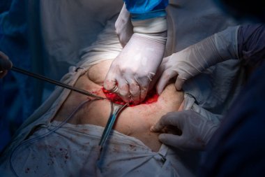 Bir cerrah bir hastanın midesini kesiyor. Hastanın kanaması var ve cerrah kanamayı durdurmaya çalışıyor.