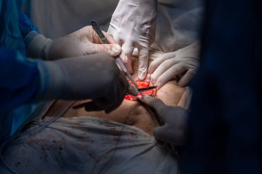 Bir grup cerrah bir hastaya ameliyat yapıyor. Cerrahlar görevlerine odaklandığı için sahne yoğun ve ciddi. Hasta masanın üzerinde yatıyor.