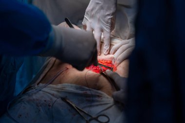 Bir cerrah bir hastanın midesini kesiyor. Hasta hastanede ve olay yeri çok dramatik.