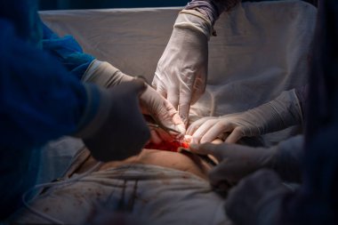 Bir grup cerrah bir hastaya ameliyat yapıyor. Cerrahlar görevlerine odaklandığı için sahne yoğun ve ciddi. Hasta masanın üzerinde yatıyor.