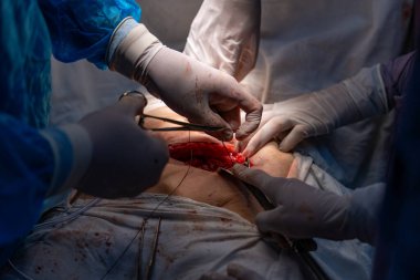 Bir grup cerrah bir hastaya ameliyat yapıyor. Cerrahlar görevlerine odaklandığı için sahne yoğun ve ciddi. Hasta çok acı çekiyor.