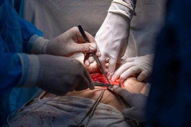 Bir grup cerrah bir hastaya ameliyat yapıyor. Cerrahlar görevlerine odaklandığı için sahne yoğun ve ciddi. Hasta masanın üzerinde yatıyor.