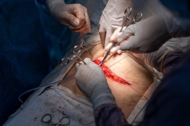 Bir cerrah bir hastanın midesini kesiyor. Hasta hastanede ve ameliyat bir grup doktor tarafından gerçekleştiriliyor.