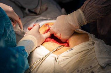 Bir cerrah bir hastanın midesini kesiyor. Hastanın kanaması var ve cerrah eldiven giyiyor.