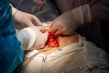 Bir cerrah bir hastanın midesini kesiyor. Hastanın kanaması var ve cerrah kanamayı durdurmaya çalışıyor.