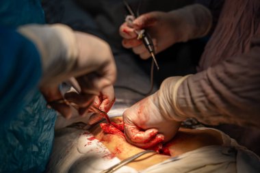 Bir cerrah bir hastanın vücudunu kesiyor. Hastanın kanaması var ve cerrah kesiği açmak için neşter kullanıyor.