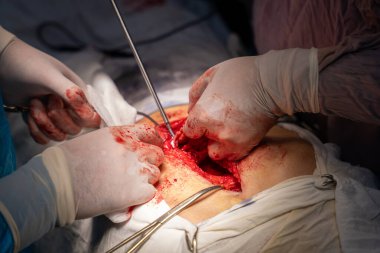 Bir cerrah bir hastanın midesini kesiyor. Olay yeri kanlı ve yoğun. Cerrah eldiven ve maske takıyor ve hasta masanın üzerinde yatıyor.