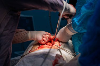 Bir cerrah bir hastanın midesini kesiyor. Hastanın kanaması var ve cerrah kanamayı durdurmaya çalışıyor. Sahne yoğun ve dramatik.