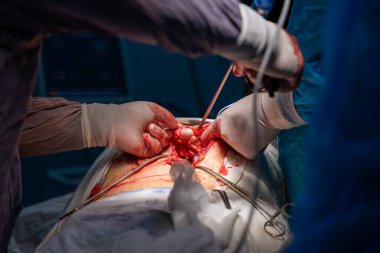 Bir cerrah bir hastanın midesini kesiyor. Hastanın kanaması var ve cerrah karnını kesmek için neşter kullanıyor.