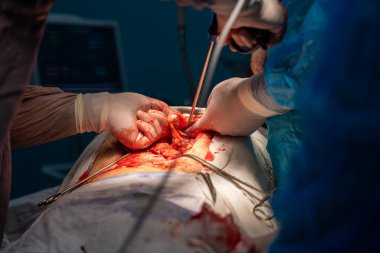 Bir cerrah bir hastanın midesini kesiyor. Hastanın kanaması var ve cerrah kanamayı durdurmaya çalışıyor.