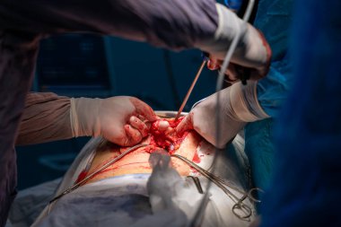 Bir cerrah bir hastanın midesini kesiyor. Hastanın kanaması var ve cerrah kanamayı durdurmaya çalışıyor.