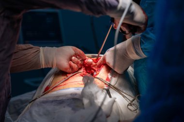 Bir cerrah bir hastanın midesini kesiyor. Hastanın kanaması var ve cerrah kanamayı durdurmaya çalışıyor.